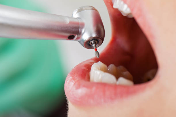 Best Knocked-Out Tooth (Avulsed Tooth) Treatment in Irvington, NY